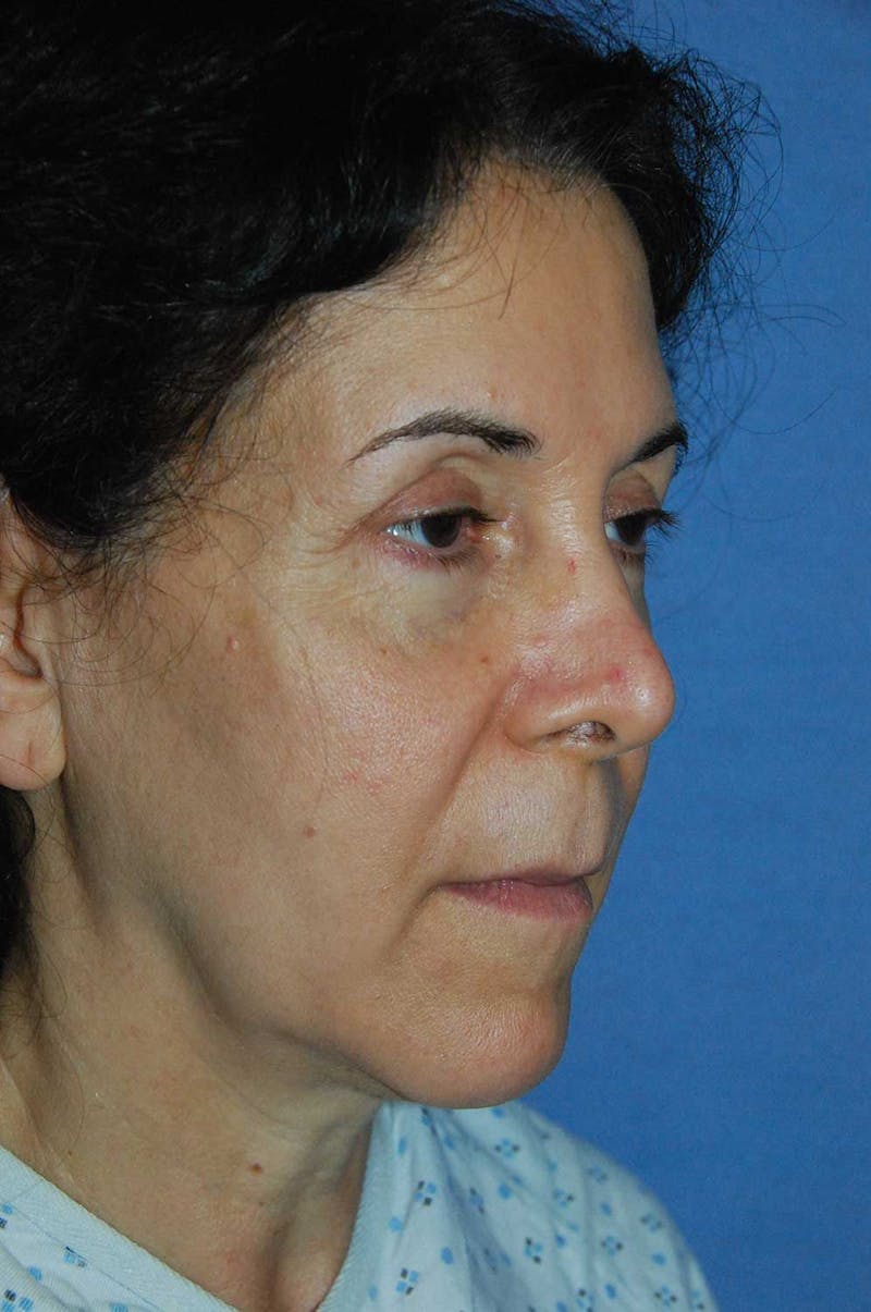YoungVitalizer Before & After Gallery - Patient 282686 - Image 1
