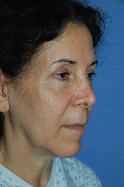 Eye Lift Before & After Gallery - Patient 388079 - Image 1