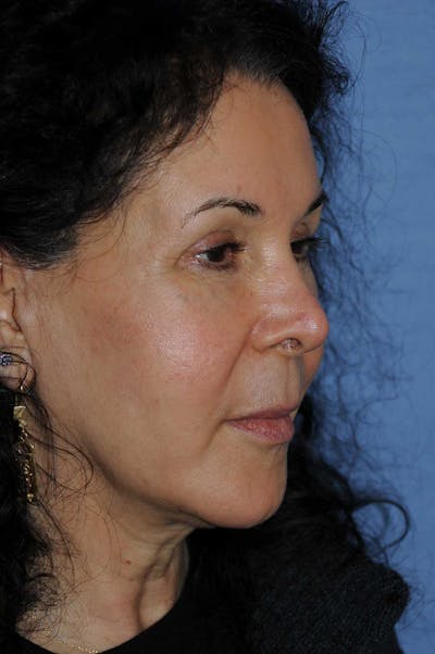 Eye Lift Before & After Gallery - Patient 388079 - Image 2