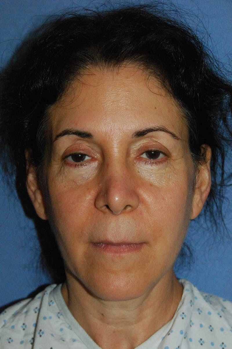 YoungVitalizer Before & After Gallery - Patient 282686 - Image 3