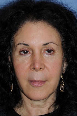 Eye Lift Before & After Gallery - Patient 388079 - Image 4
