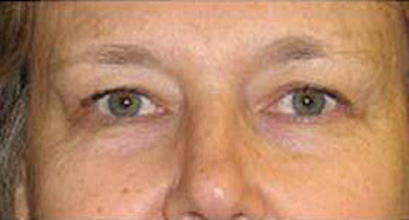 Eye Lift Before & After Gallery - Patient 420819 - Image 1