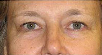 Eye Lift Before & After Gallery - Patient 420819 - Image 1