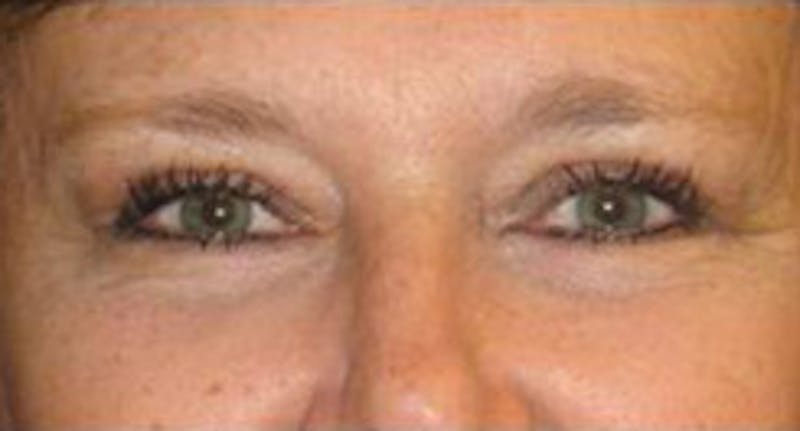 Eye Lift Before & After Gallery - Patient 420819 - Image 2