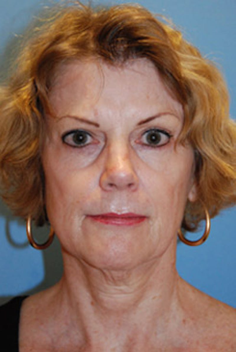 Eye Lift Before & After Gallery - Patient 427804 - Image 1