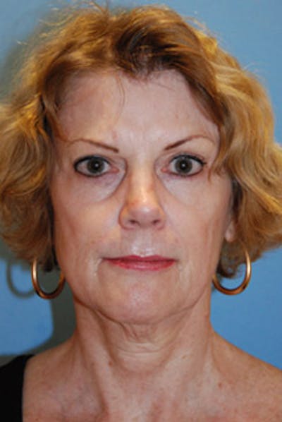 Eye Lift Before & After Gallery - Patient 427804 - Image 1