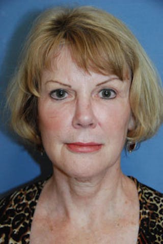 Mid Facelift Galleries Before & After Gallery - Patient 255873 - Image 2