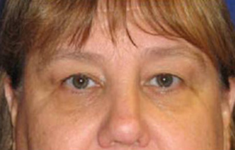 Eye Lift Before & After Gallery - Patient 109525 - Image 1