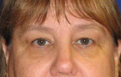 Eye Lift Before & After Gallery - Patient 109525 - Image 1