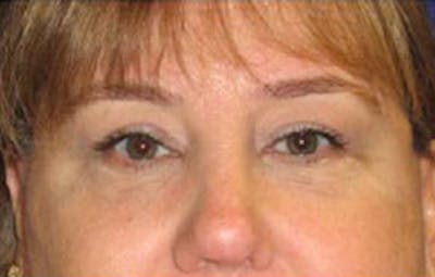 Eye Lift Before & After Gallery - Patient 109525 - Image 2