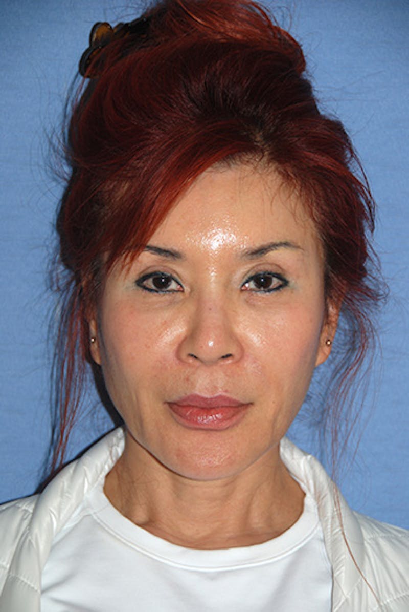 Eye Lift Before & After Gallery - Patient 235662 - Image 1