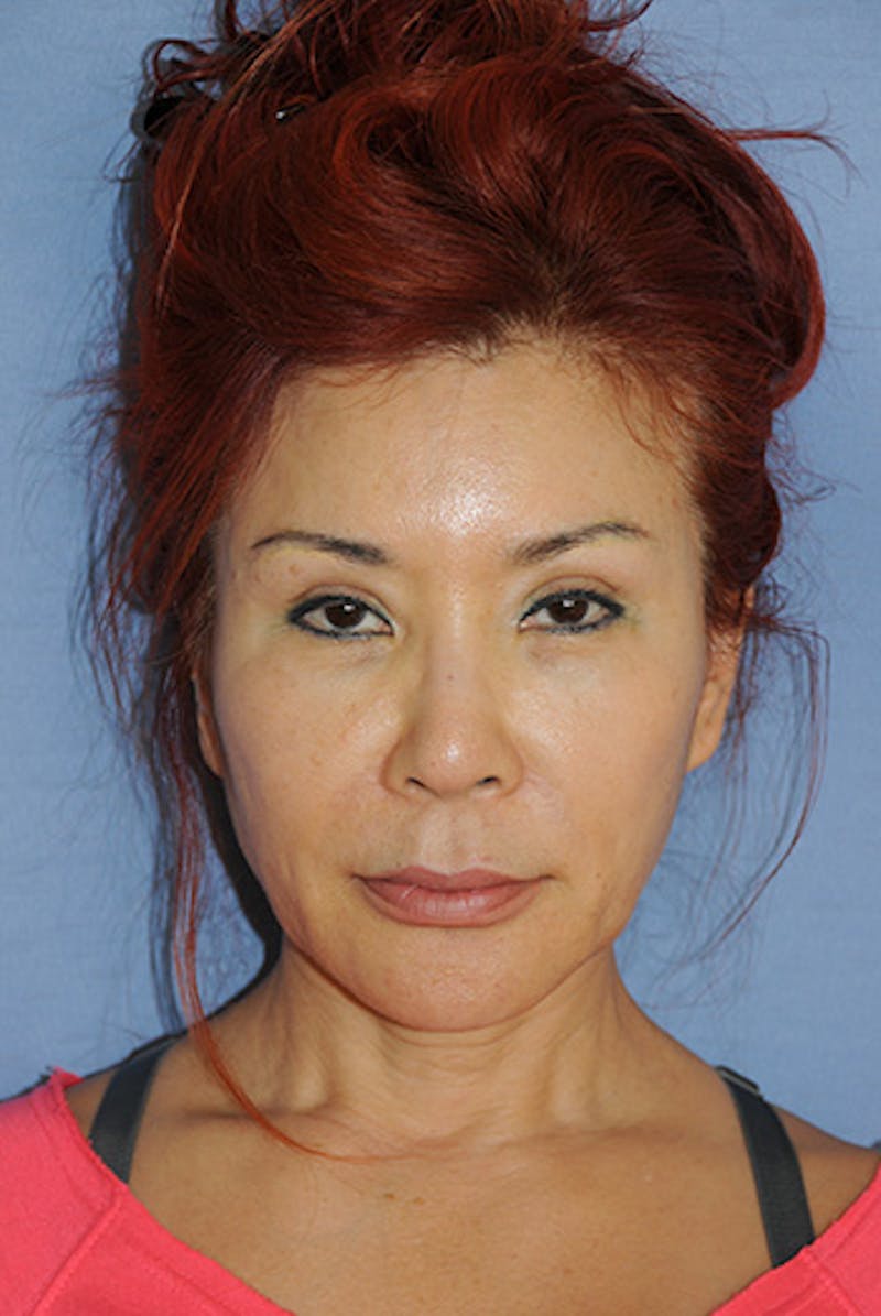 Eye Lift Before & After Gallery - Patient 235662 - Image 2