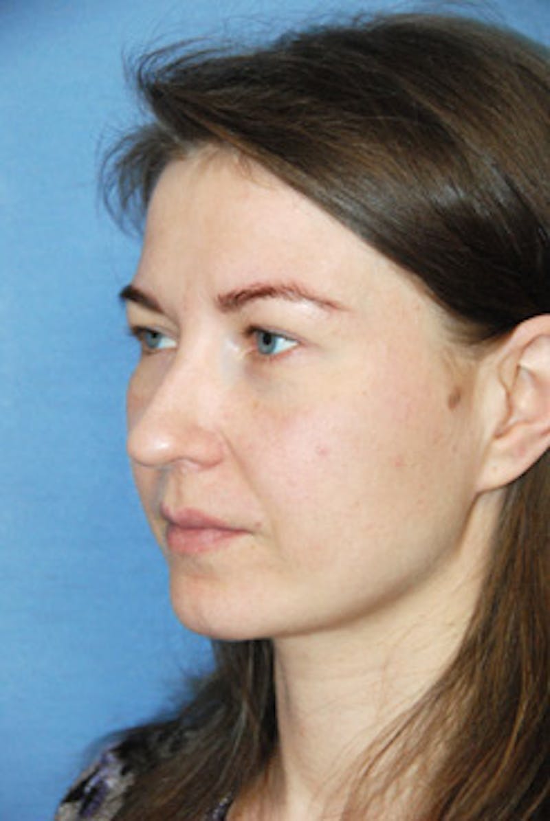 Eye Lift Before & After Gallery - Patient 359353 - Image 1