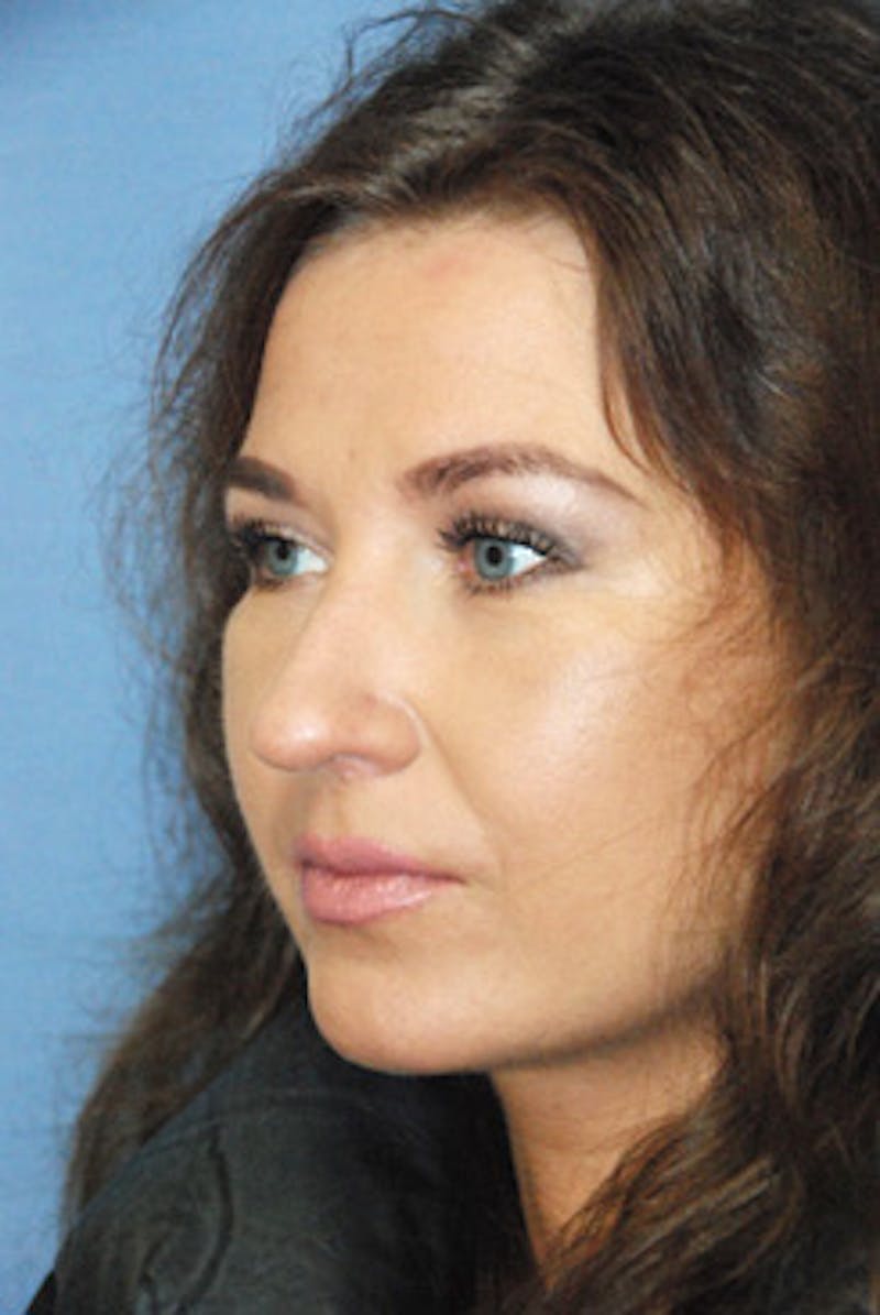 Eye Lift Before & After Gallery - Patient 359353 - Image 2