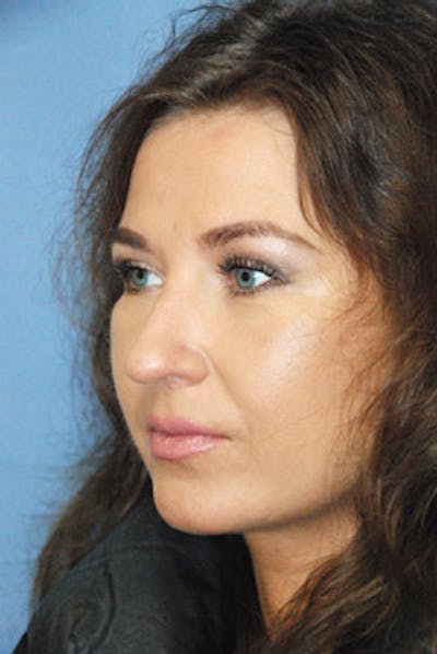 Eye Lift Before & After Gallery - Patient 359353 - Image 2