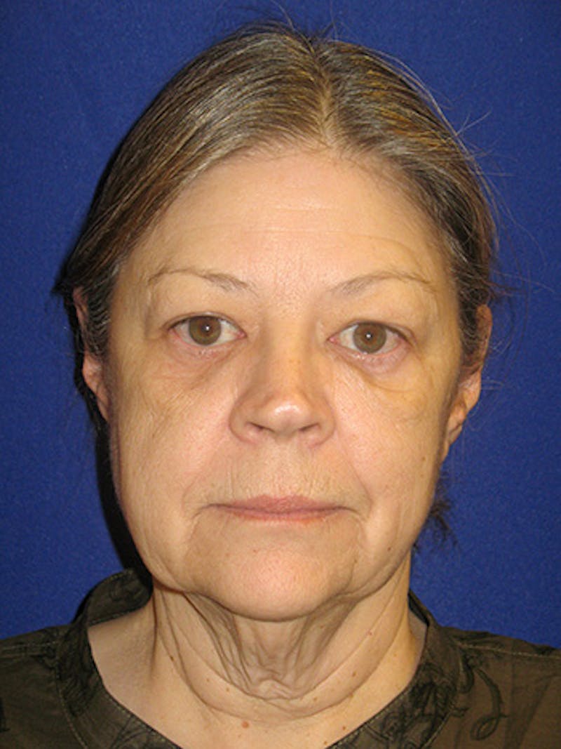Eye Lift Before & After Gallery - Patient 322897 - Image 1