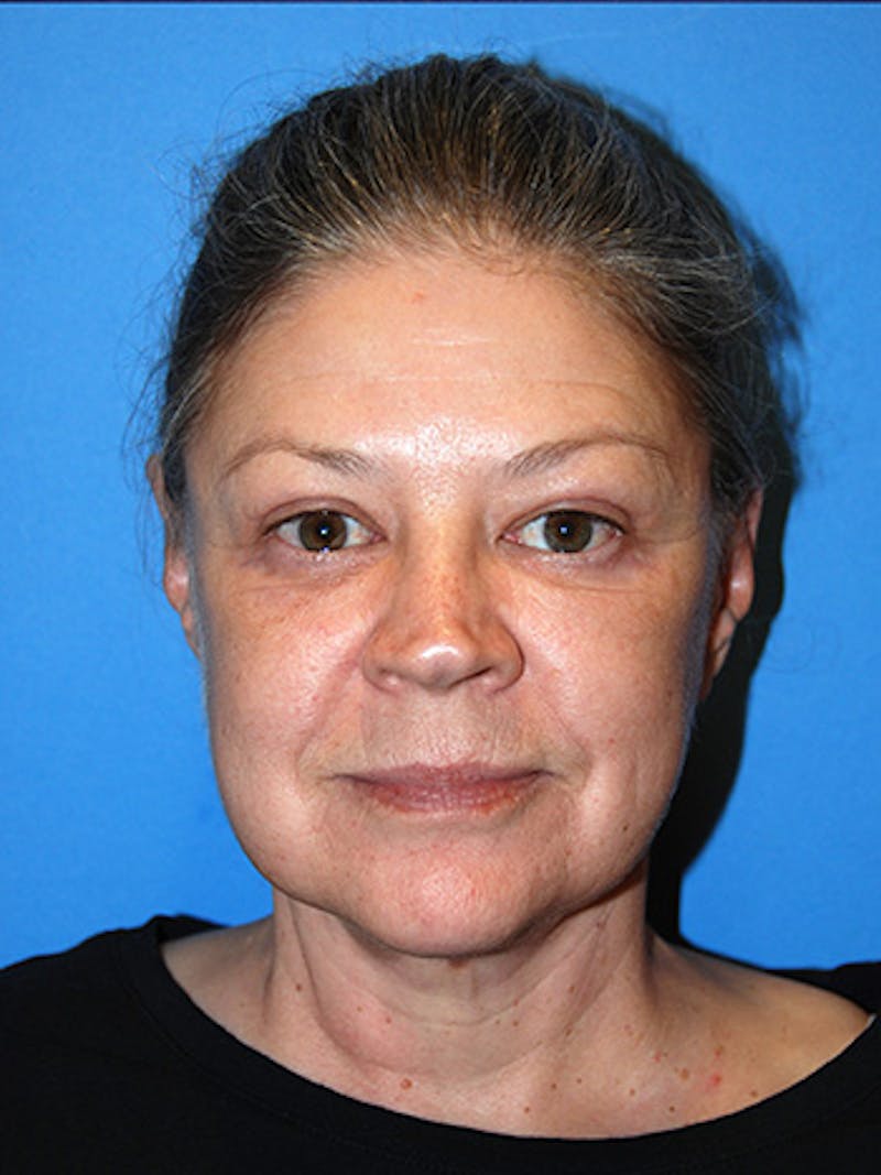Eye Lift Before & After Gallery - Patient 322897 - Image 2