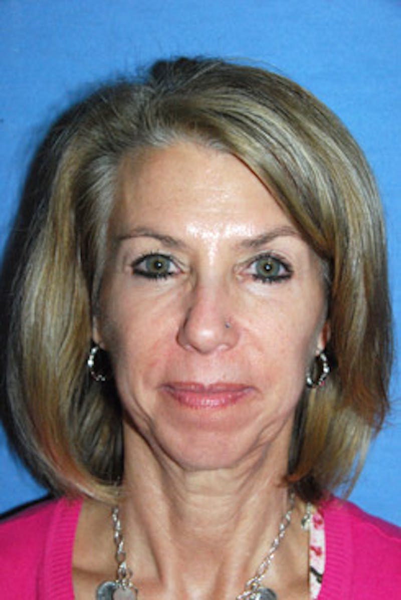 Eye Lift Before & After Gallery - Patient 892509 - Image 1