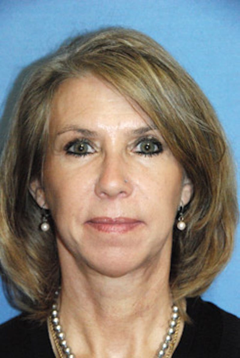 Eye Lift Before & After Gallery - Patient 892509 - Image 2