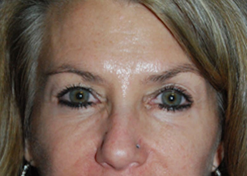 Eye Lift Before & After Gallery - Patient 892509 - Image 3