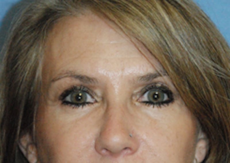 Eye Lift Before & After Gallery - Patient 892509 - Image 4