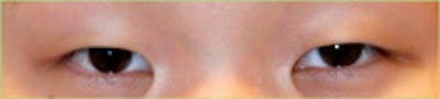 Eye Lift Before & After Gallery - Patient 394189 - Image 1