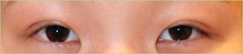 Eye Lift Before & After Gallery - Patient 394189 - Image 2