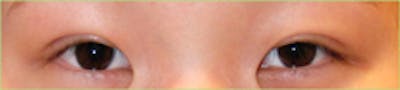 Eye Lift Before & After Gallery - Patient 394189 - Image 2