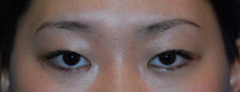 Eye Lift Before & After Gallery - Patient 144972 - Image 1