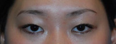 Eye Lift Before & After Gallery - Patient 144972 - Image 1