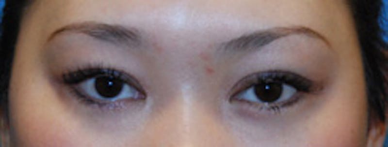 Eye Lift Before & After Gallery - Patient 144972 - Image 2