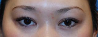 Eye Lift Before & After Gallery - Patient 144972 - Image 2