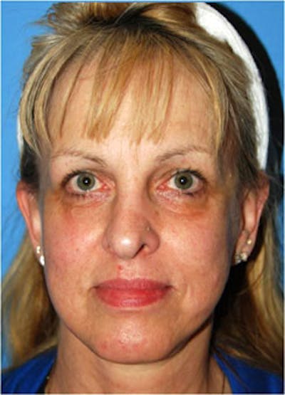 Eye Lift Before & After Gallery - Patient 146501 - Image 1