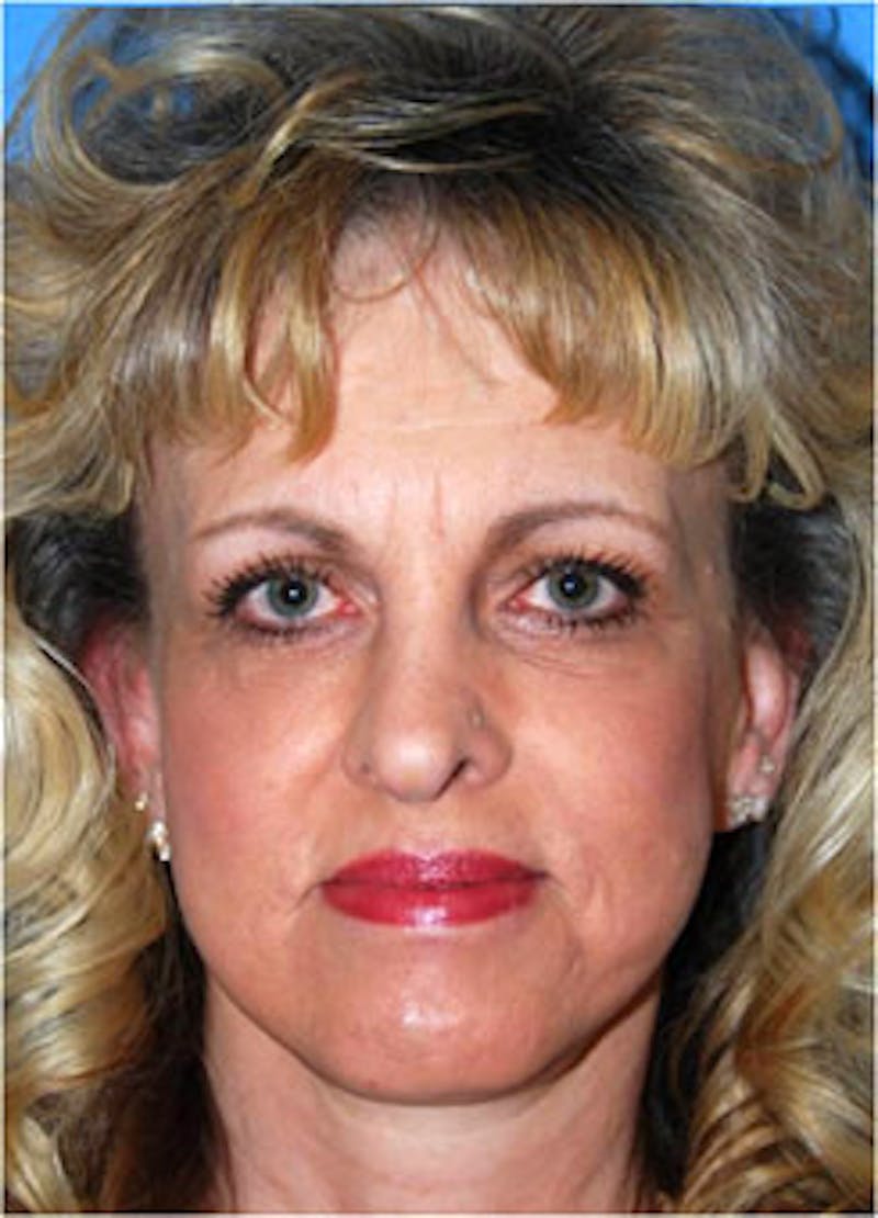 Eye Lift Before & After Gallery - Patient 146501 - Image 2