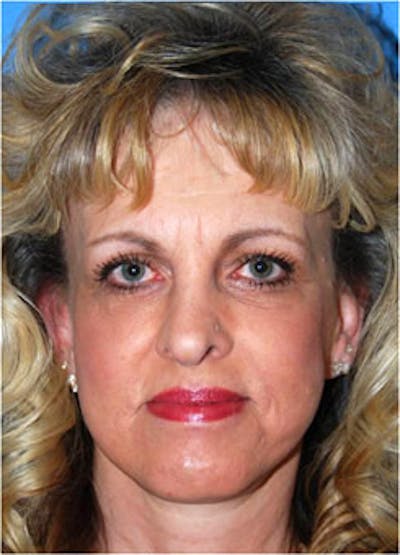 Eye Lift Before & After Gallery - Patient 146501 - Image 2