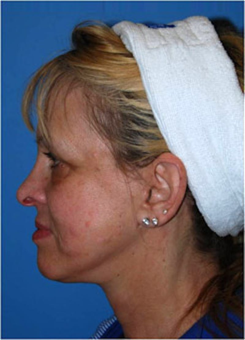 Eye Lift Before & After Gallery - Patient 146501 - Image 3