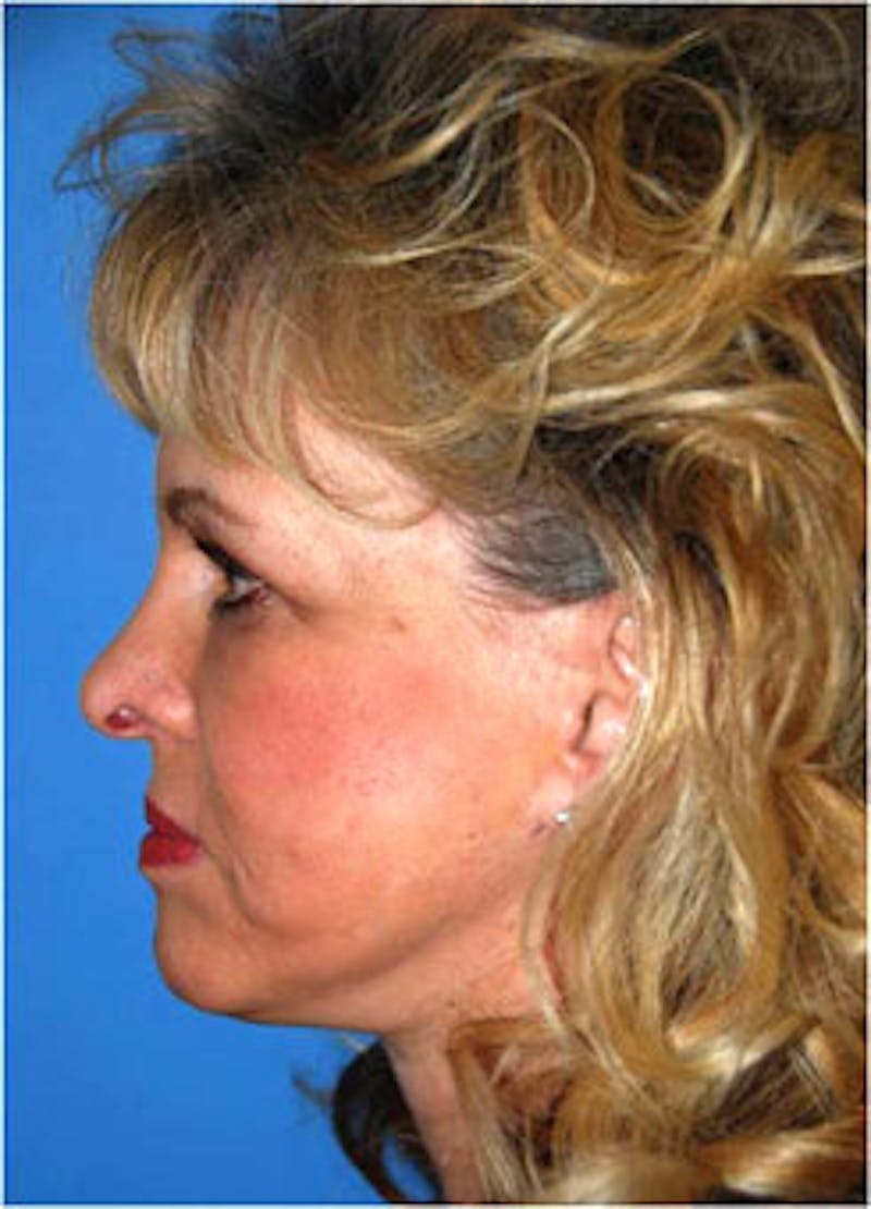 Eye Lift Before & After Gallery - Patient 146501 - Image 4
