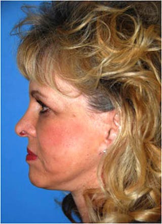 Mid Facelift Galleries Before & After Gallery - Patient 403769 - Image 4