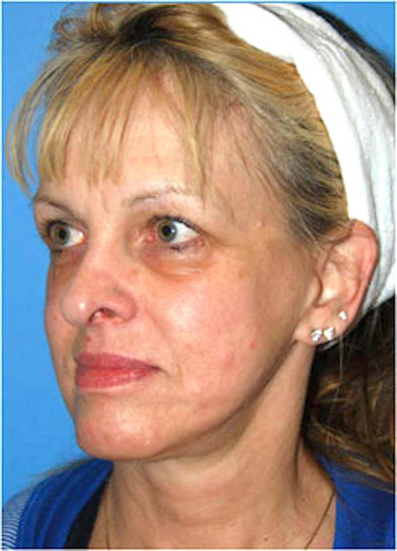 Eye Lift Before & After Gallery - Patient 146501 - Image 5