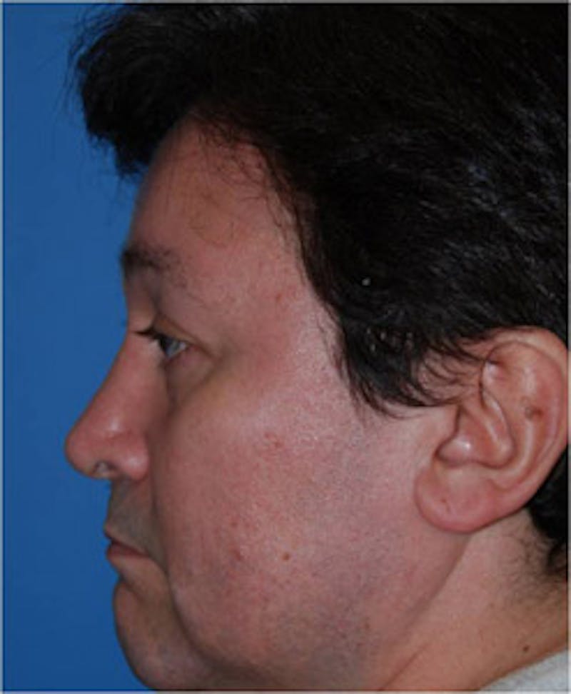 Eye Lift Before & After Gallery - Patient 206467 - Image 3