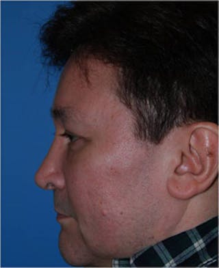 Eye Lift Before & After Gallery - Patient 206467 - Image 4