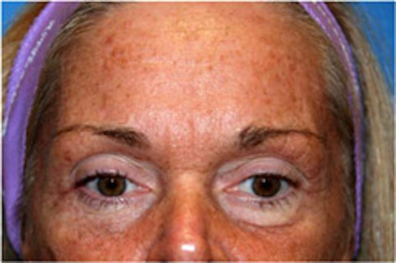 Fat Transfer Before & After Gallery - Patient 719318 - Image 1