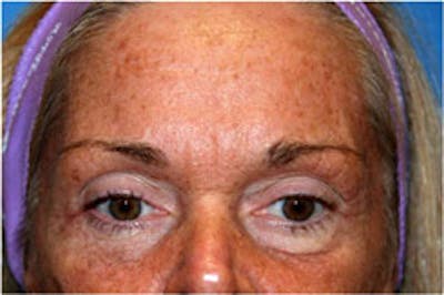 Eye Lift Before & After Gallery - Patient 416459 - Image 1
