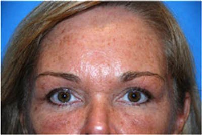 Eye Lift Before & After Gallery - Patient 416459 - Image 2