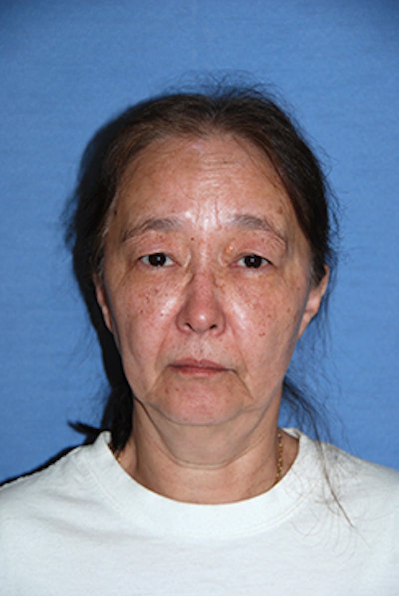 Facelift Before & After Gallery - Patient 330189 - Image 1