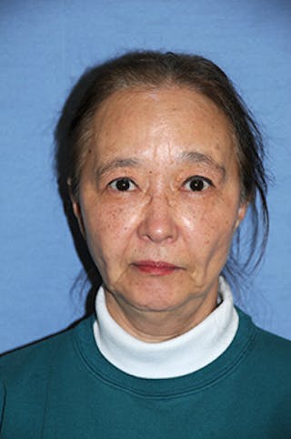 Eye Lift Before & After Gallery - Patient 354785 - Image 2