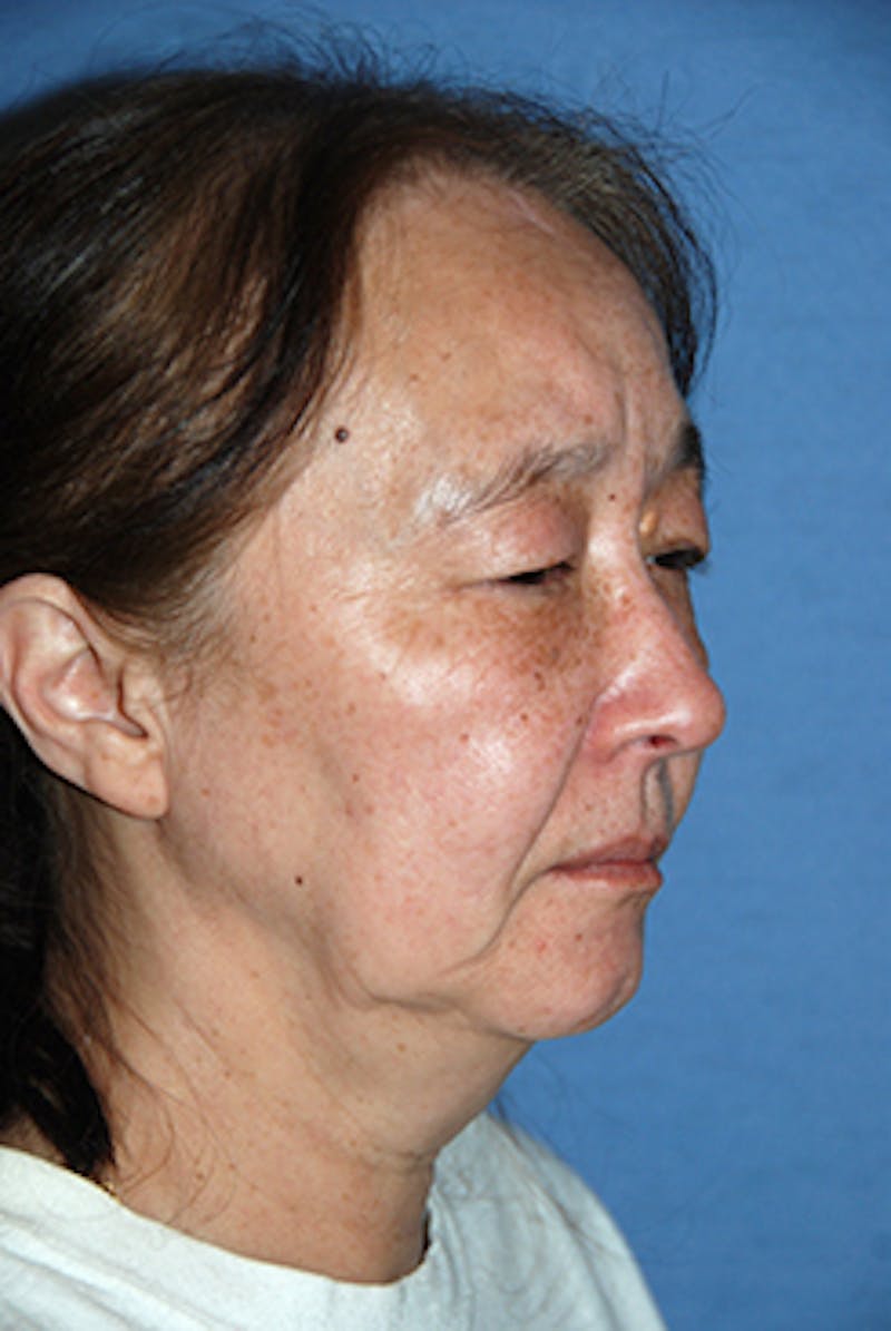 Eye Lift Before & After Gallery - Patient 354785 - Image 3