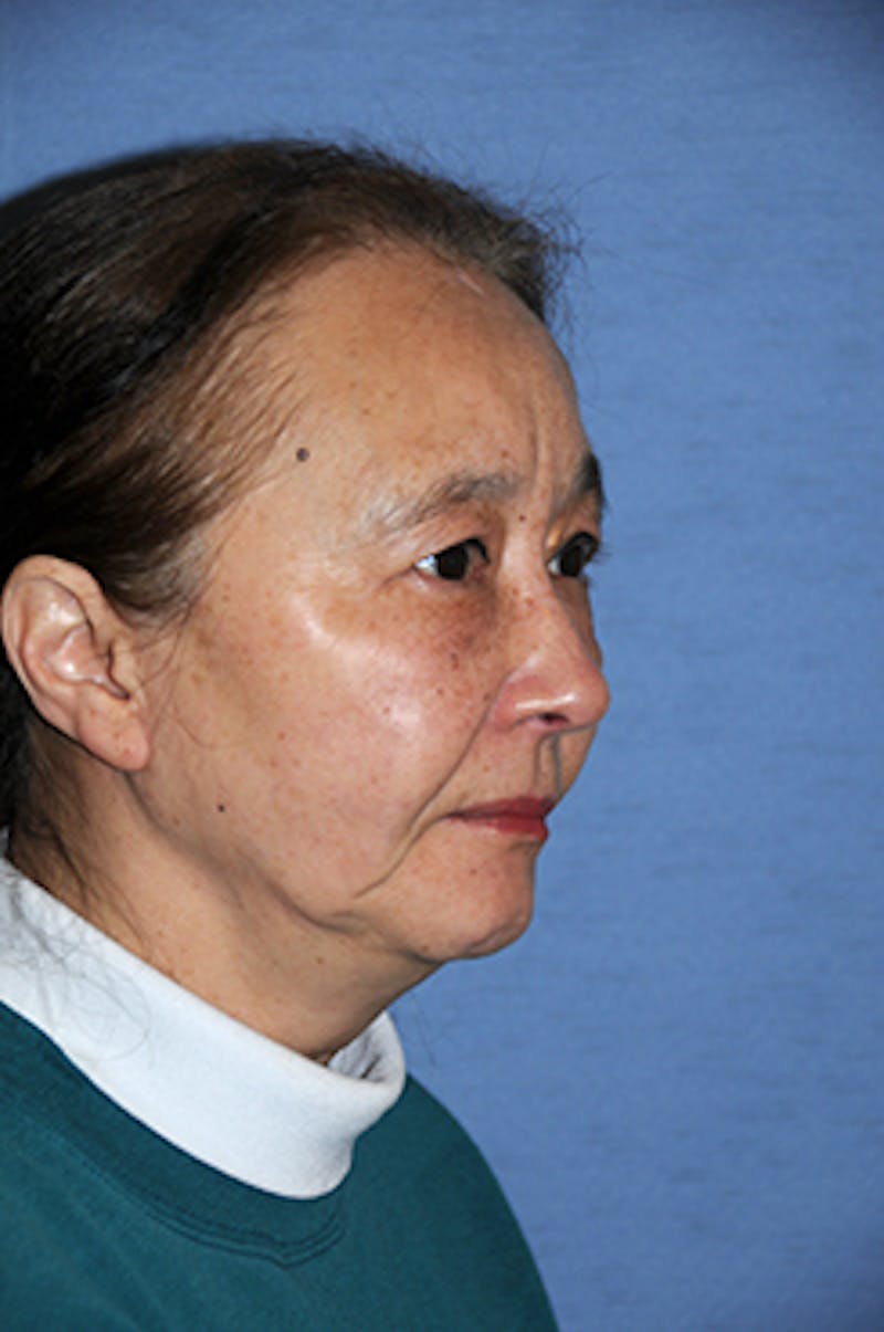 Eye Lift Before & After Gallery - Patient 354785 - Image 4