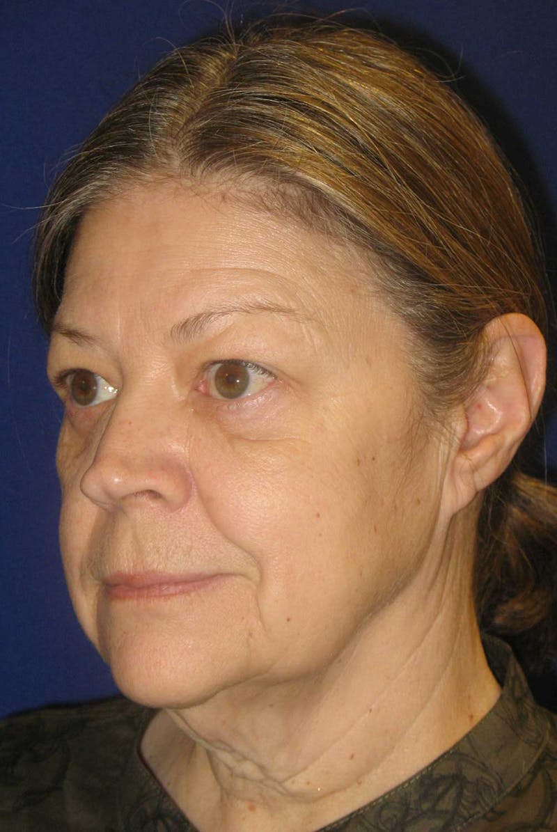 Facelift Before & After Gallery - Patient 222565 - Image 3