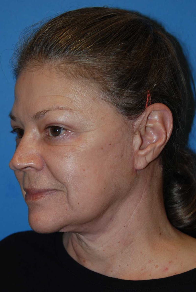 Facelift Before & After Gallery - Patient 222565 - Image 4